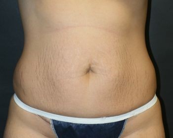 Tummy Tuck - Before & After - Dr. Placik