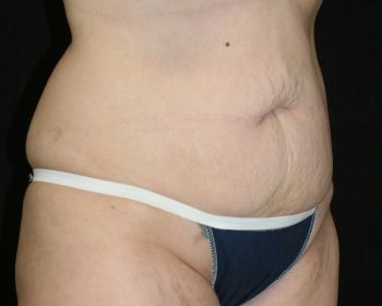 Tummy Tuck