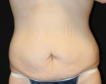 Tummy Tuck Chicago