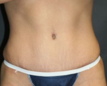 Tummy Tuck - Before & After - Dr. Placik