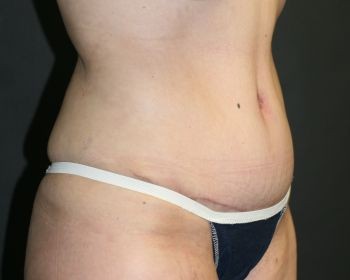 Tummy Tuck