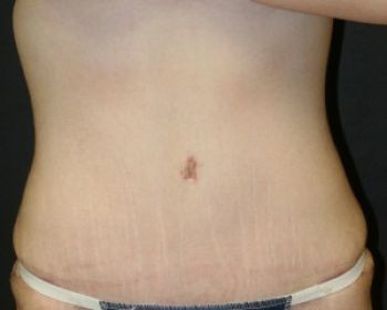 Tummy Tuck Chicago