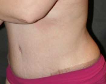 Tummy Tuck Chicago