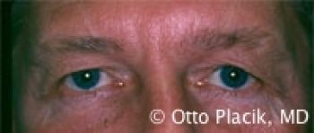 Male Blepharoplasty - Before & After - Dr. Placik