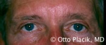 Male Blepharoplasty - Before & After - Dr. Placik