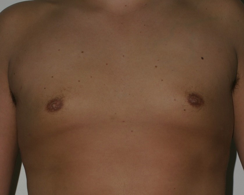 Male Breast Reduction - Before & After - Dr. Placik