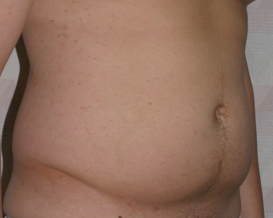 Male Liposuction - Before & After - Dr. Placik