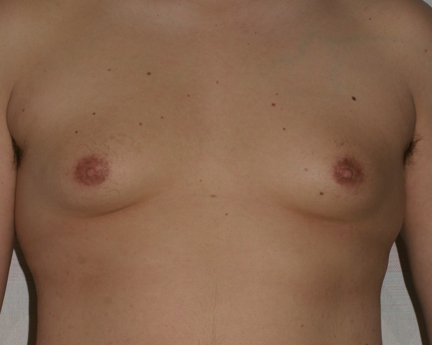 Male Breast Reduction - Before & After - Dr. Placik