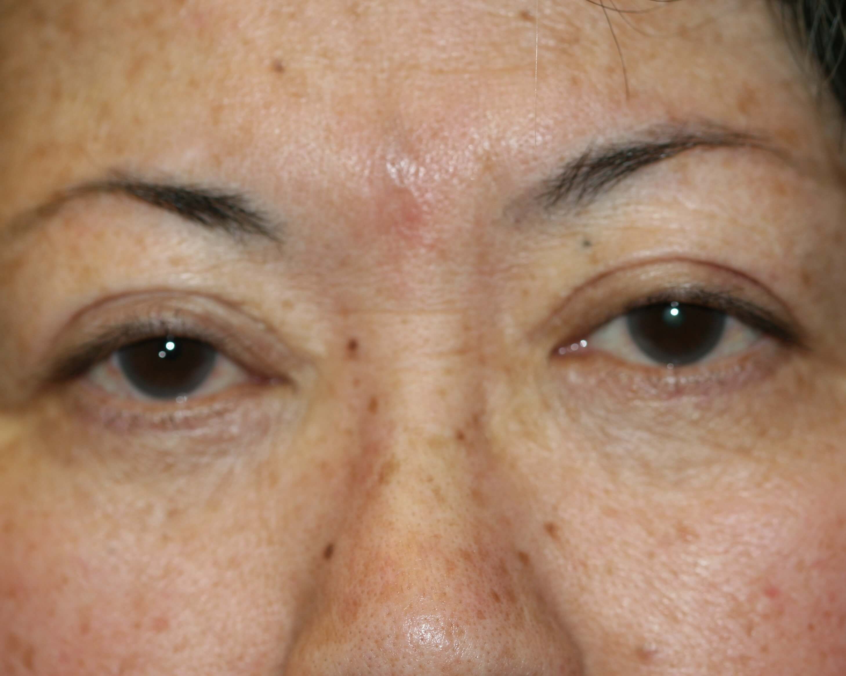 Eyelid Surgery - Before & After - Dr. Placik