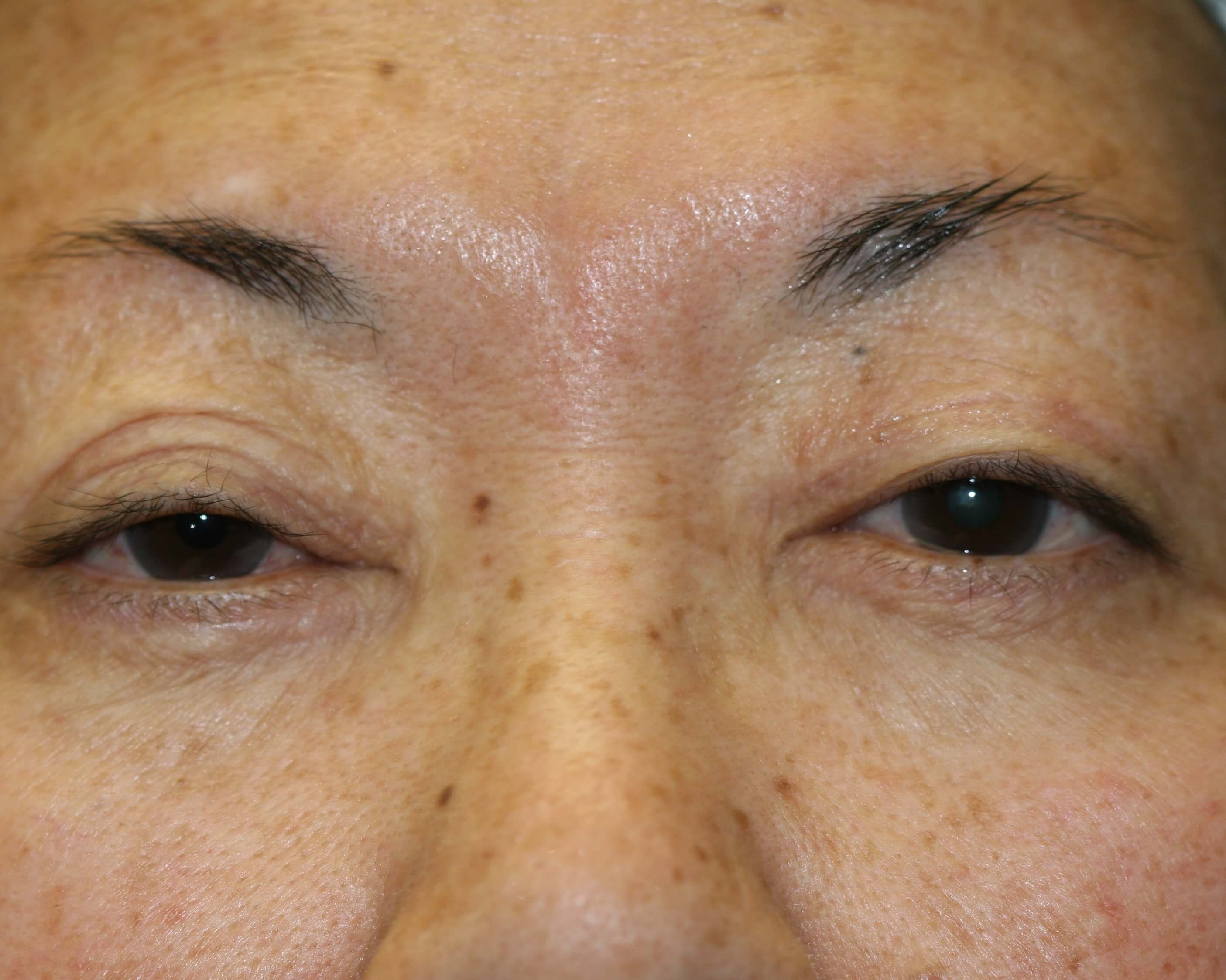 Eyelid Surgery - Before & After - Dr. Placik