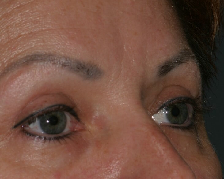 Eyelid Surgery - Before & After - Dr. Placik