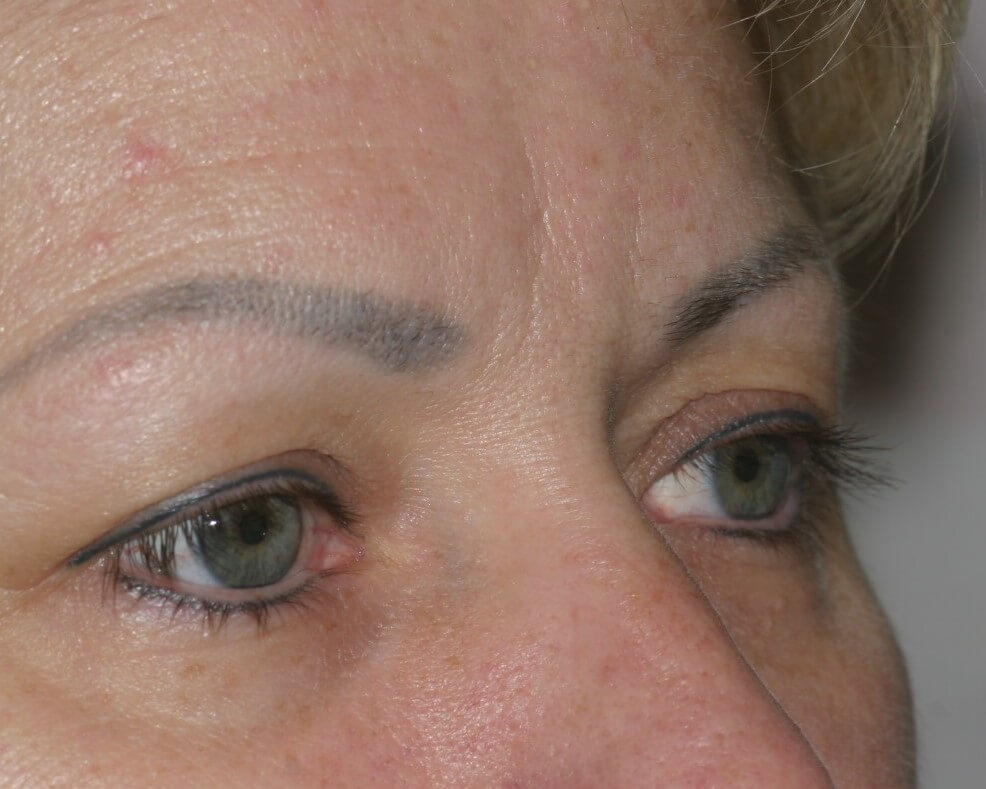 Eyelid Surgery - Before & After - Dr. Placik