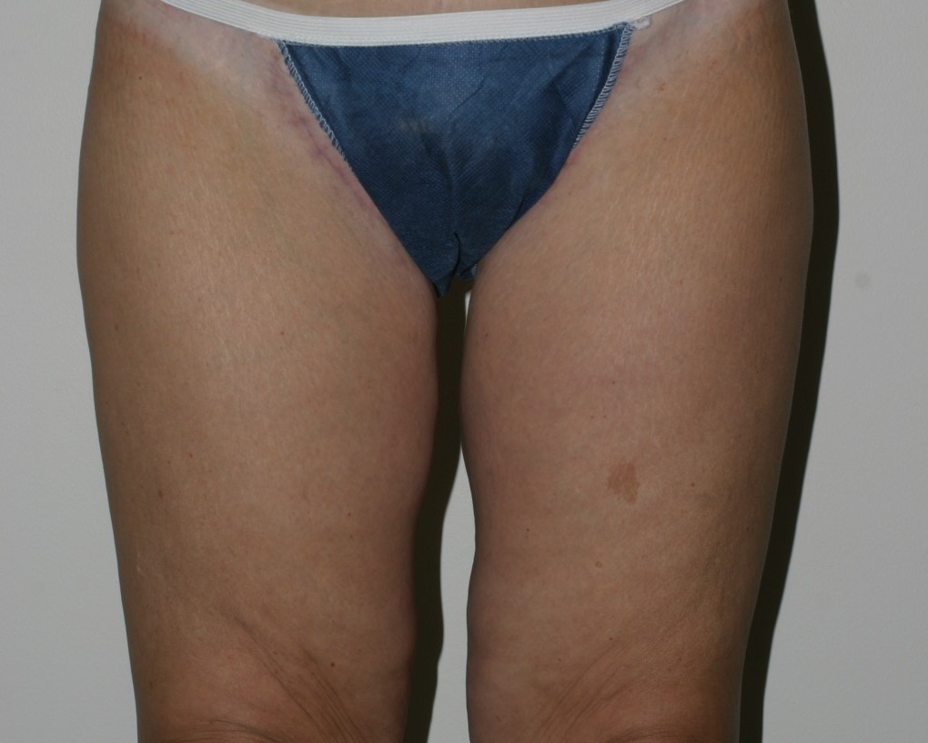 Thigh Lift - Before & After - Dr. Placik