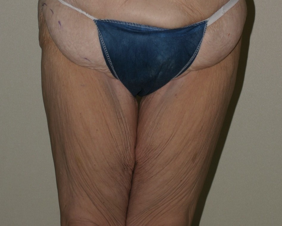 Thigh Lift - Before & After - Dr. Placik