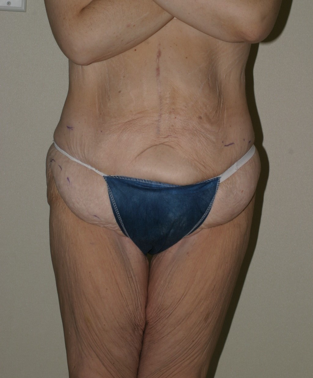 Body Lift - Before & After - Dr. Placik