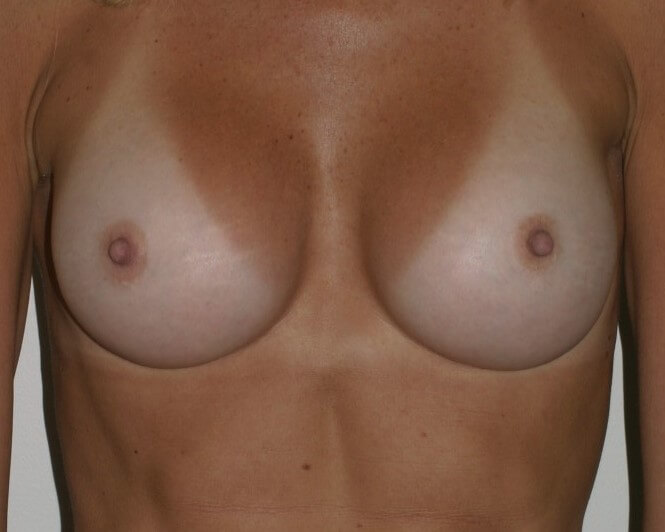 Before & After Breast Augmentation Gallery - Before & After - Dr. Placik