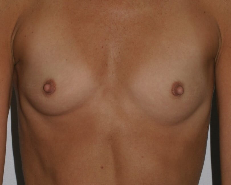 Before & After Breast Augmentation Gallery - Before & After - Dr. Placik