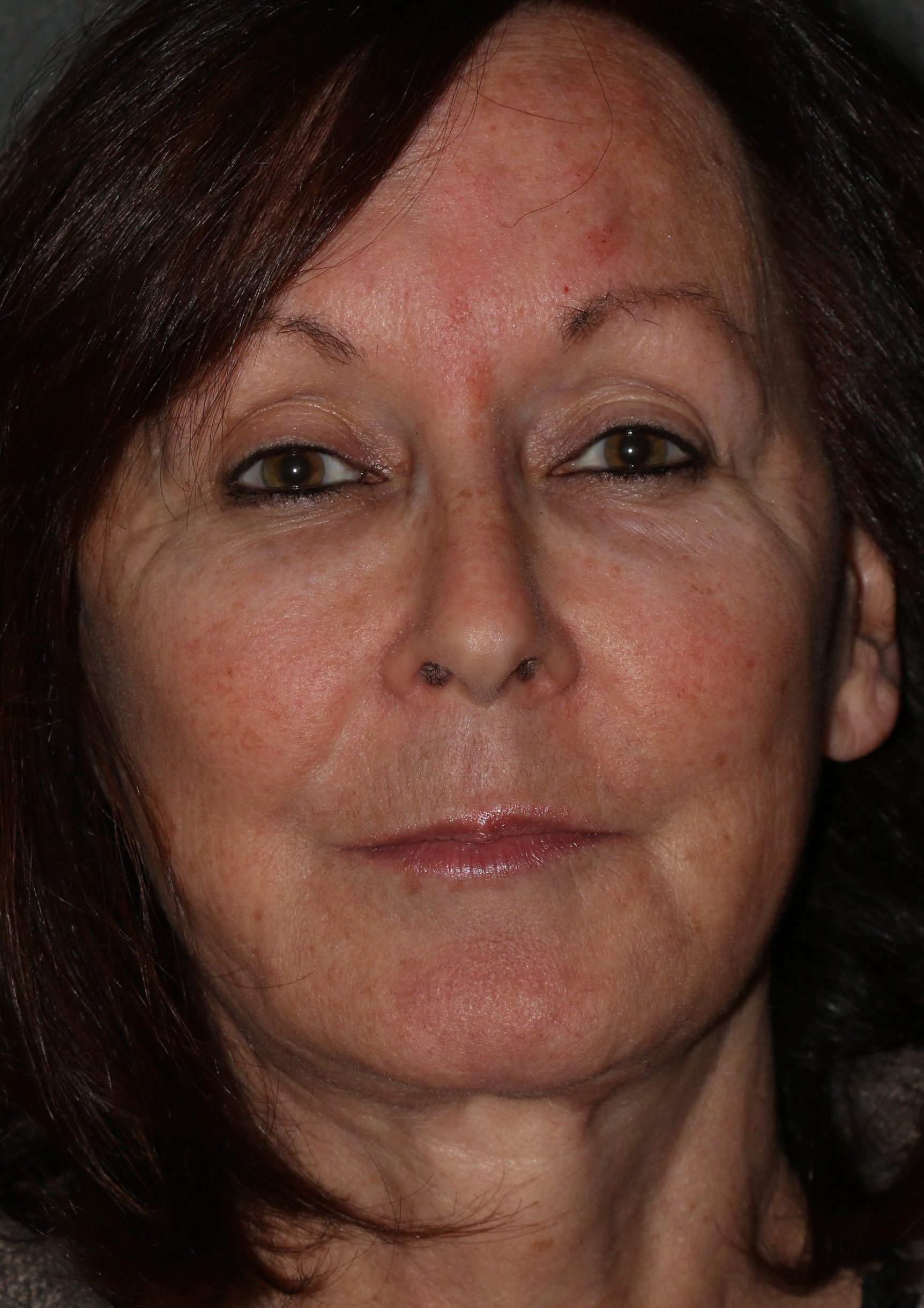 Face Lift - Before & After - Dr. Placik