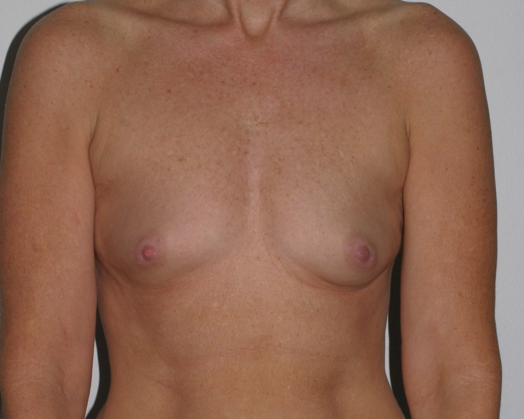 Before & After Breast Augmentation Gallery - Before & After - Dr. Placik