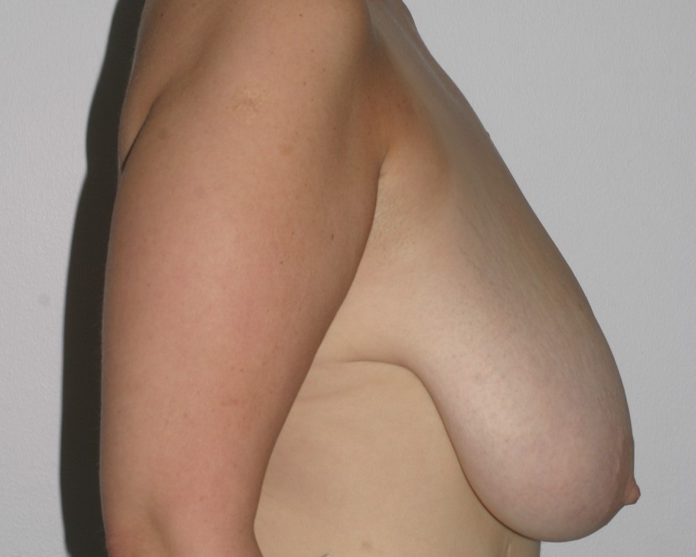 Breast Reduction - Before & After - Dr. Placik