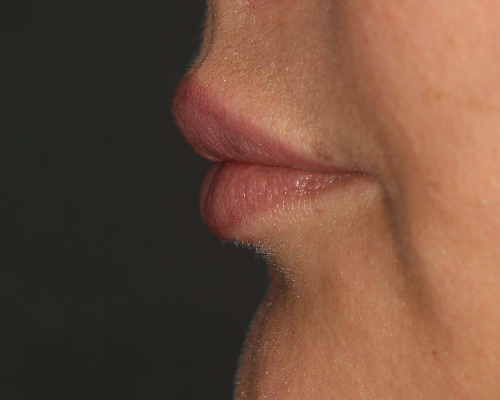 Lip Enhancement - Before & After - Dr. Placik