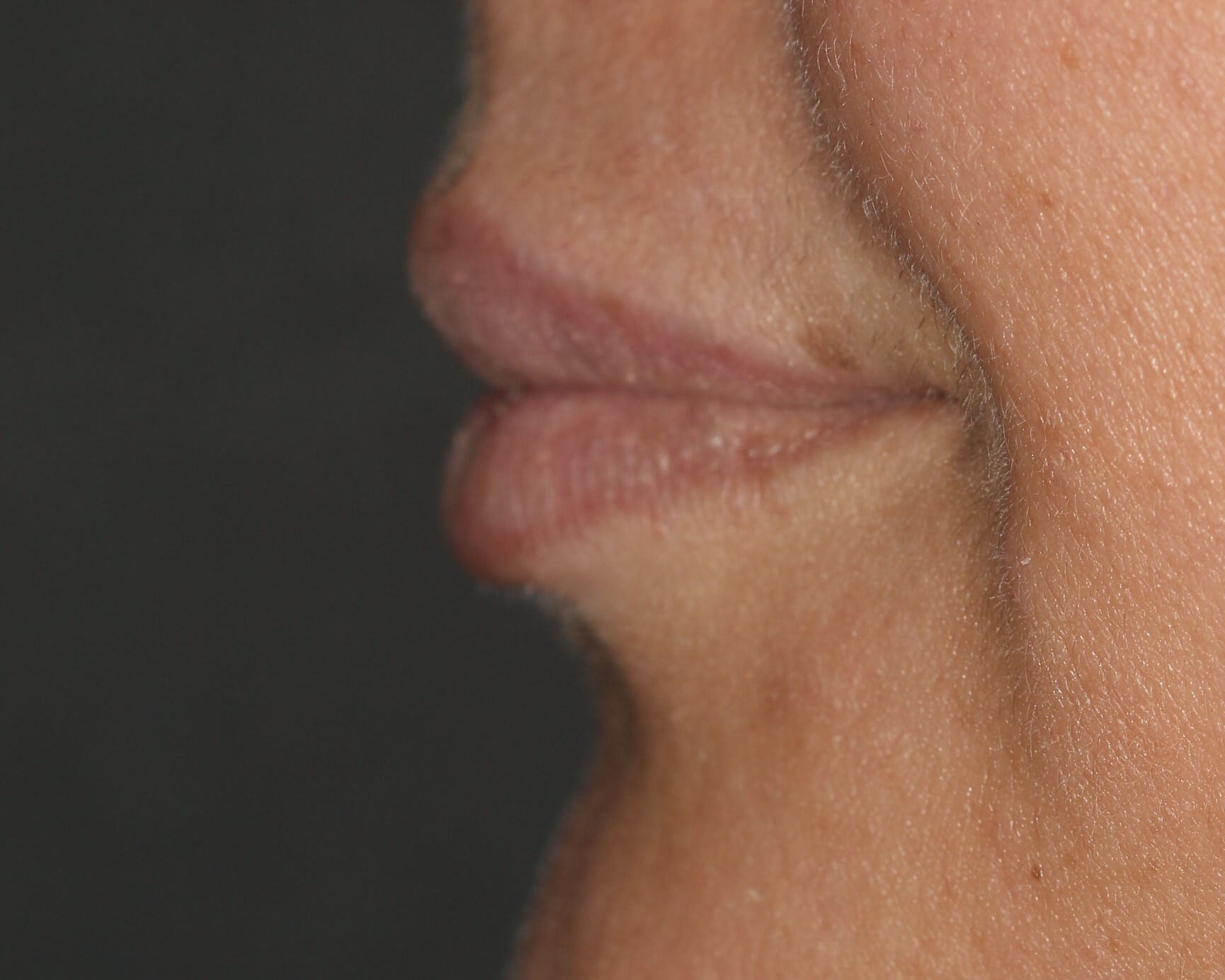 Lip Enhancement - Before & After - Dr. Placik