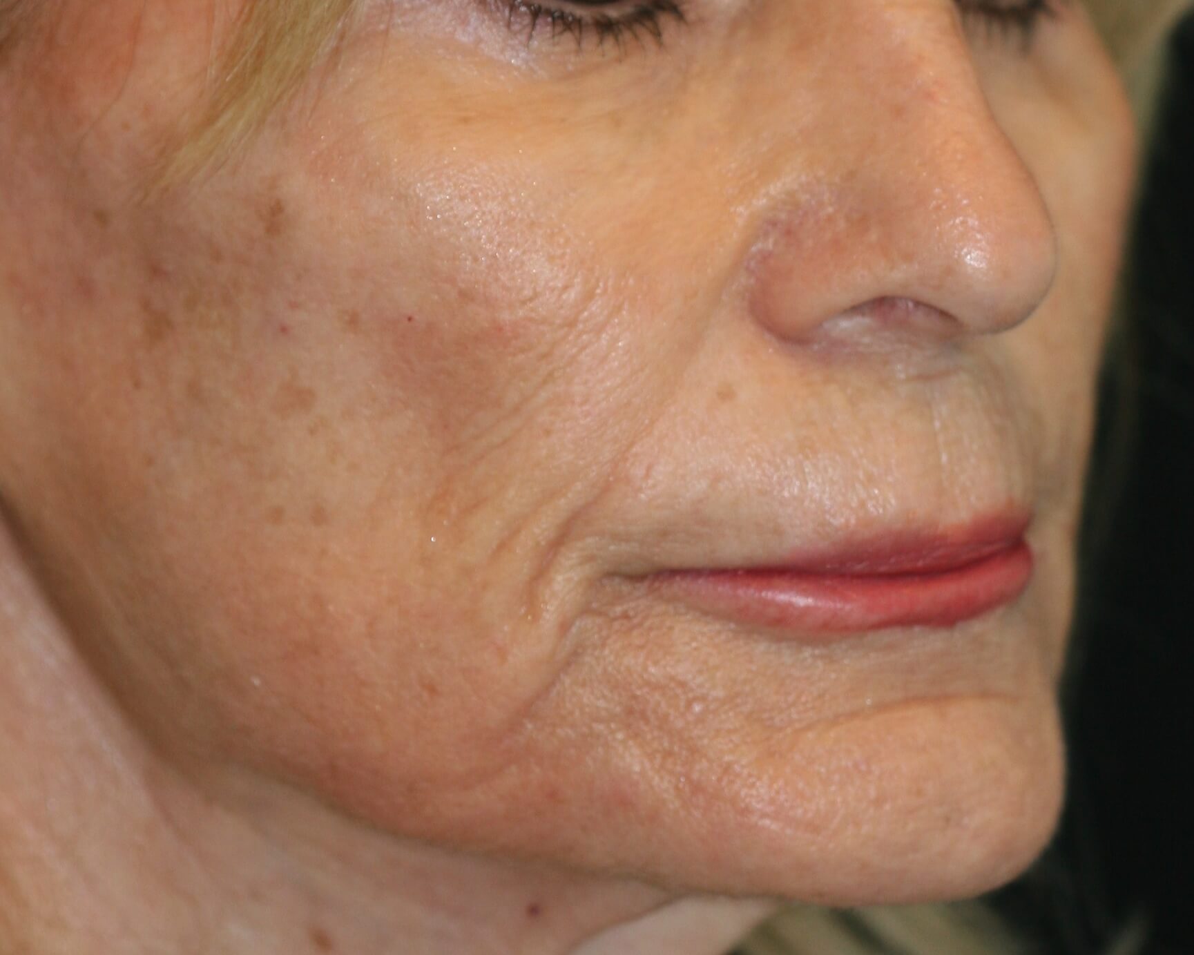 Injectable Filler - Before & After - Dr. Placik