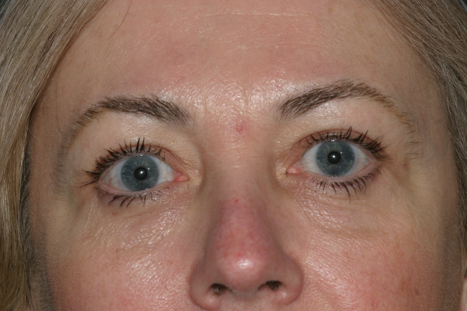 Eyelid Surgery - Before & After - Dr. Placik