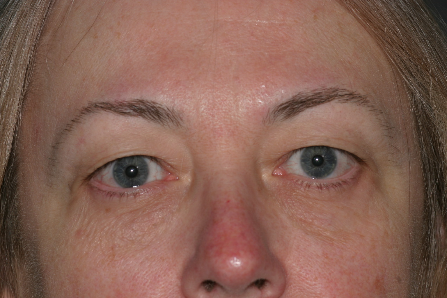 Eyelid Surgery - Before & After - Dr. Placik