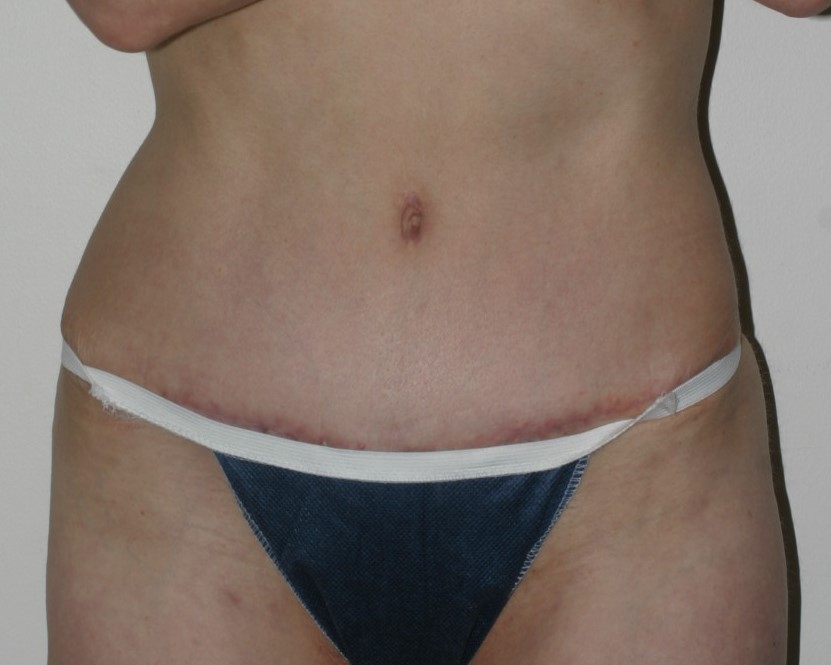 Abdominoplasty with Muscle Repair & Liposuction