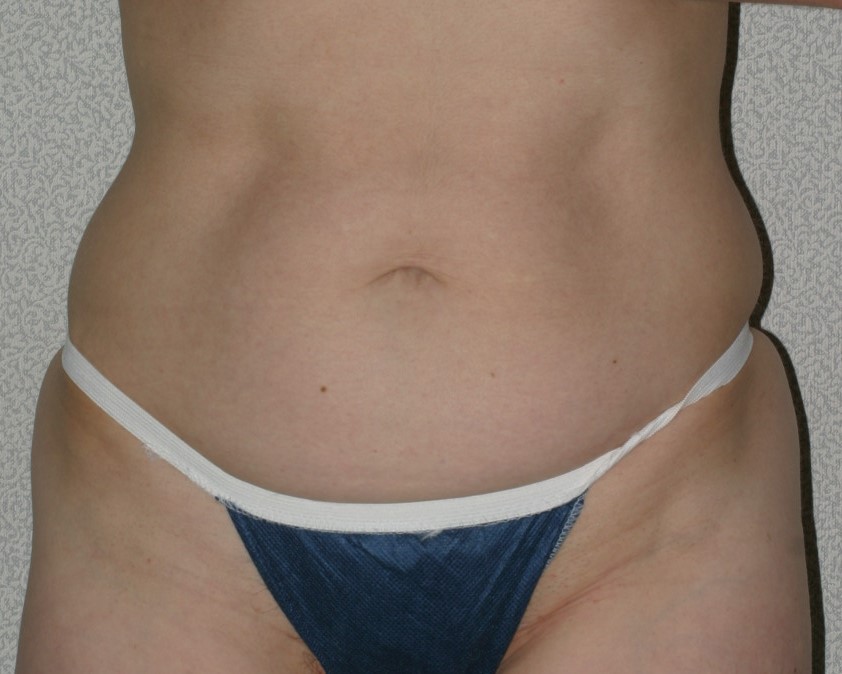 Abdominoplasty with Muscle Repair & Liposuction