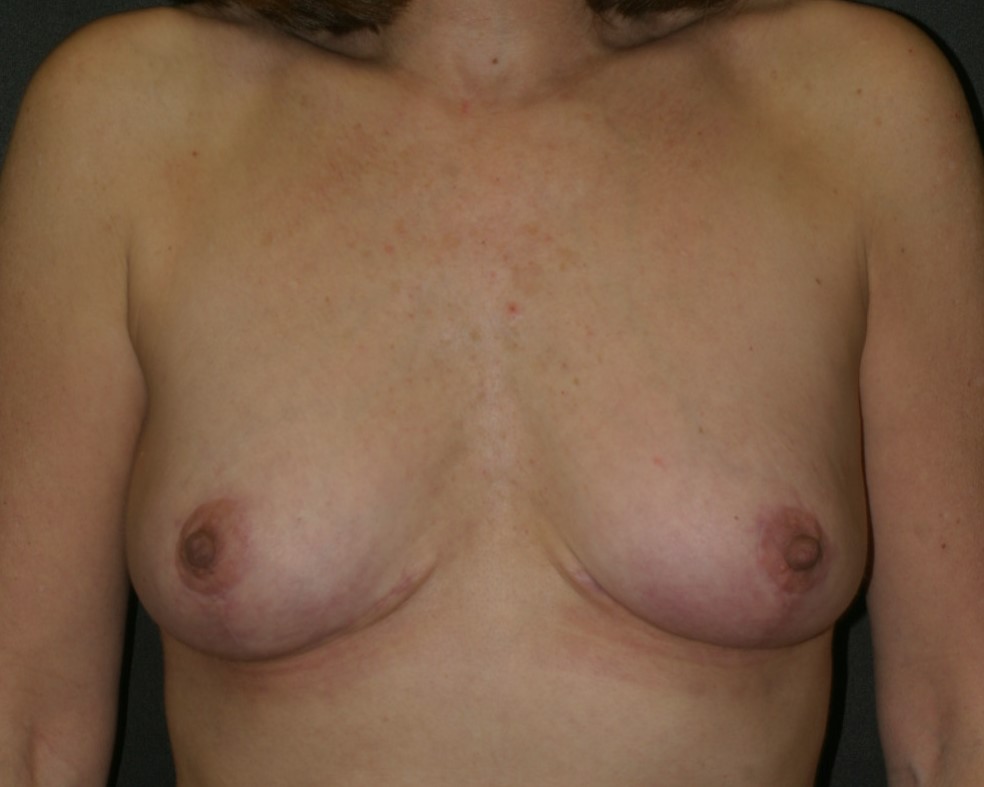 Breast Lift - Before & After - Dr. Placik