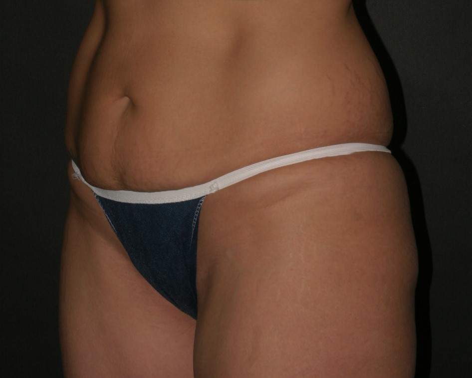 Tummy Tuck - Before & After - Dr. Placik