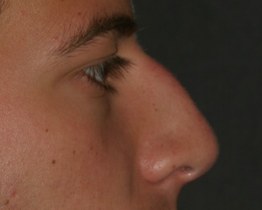 Male Rhinoplasty - Before & After - Dr. Placik