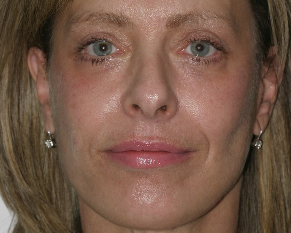 Rhytidectomy & Macs Lift. Lipoinjection to Nasolabial Folds.