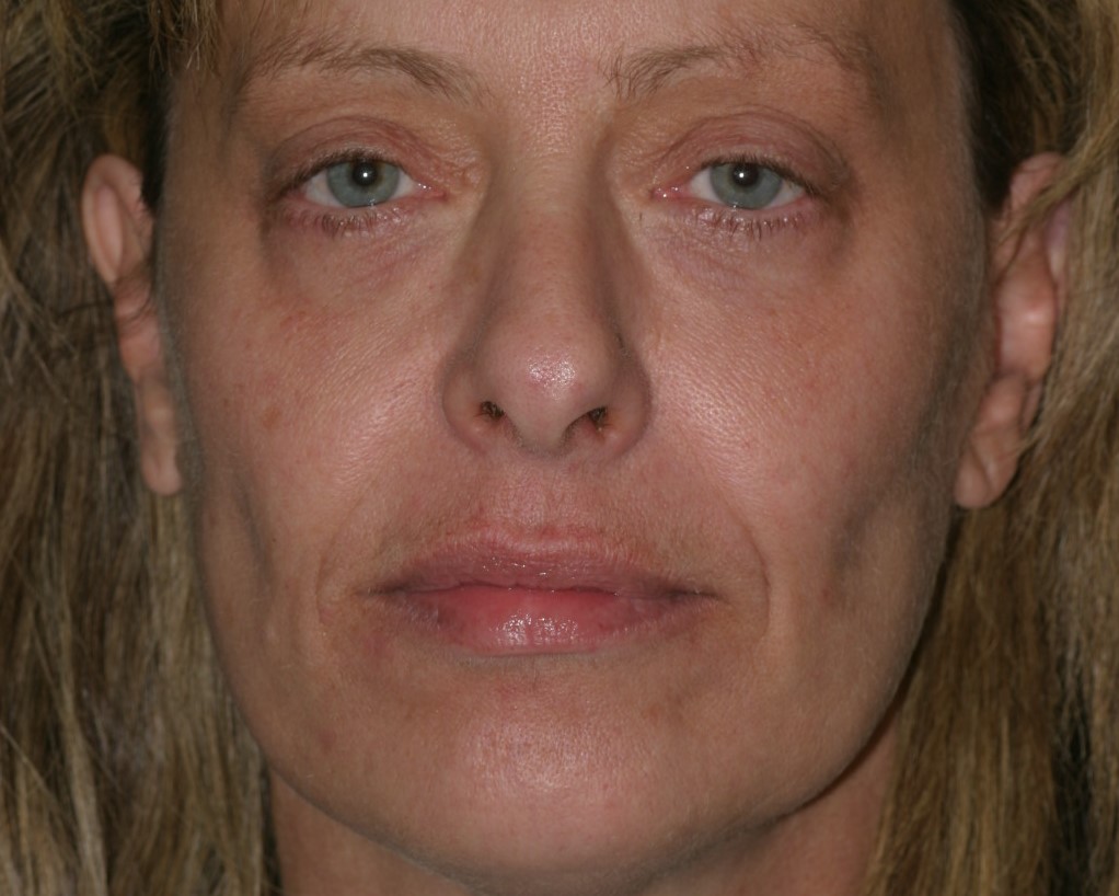 Rhytidectomy & Macs Lift. Lipoinjection to Nasolabial Folds.