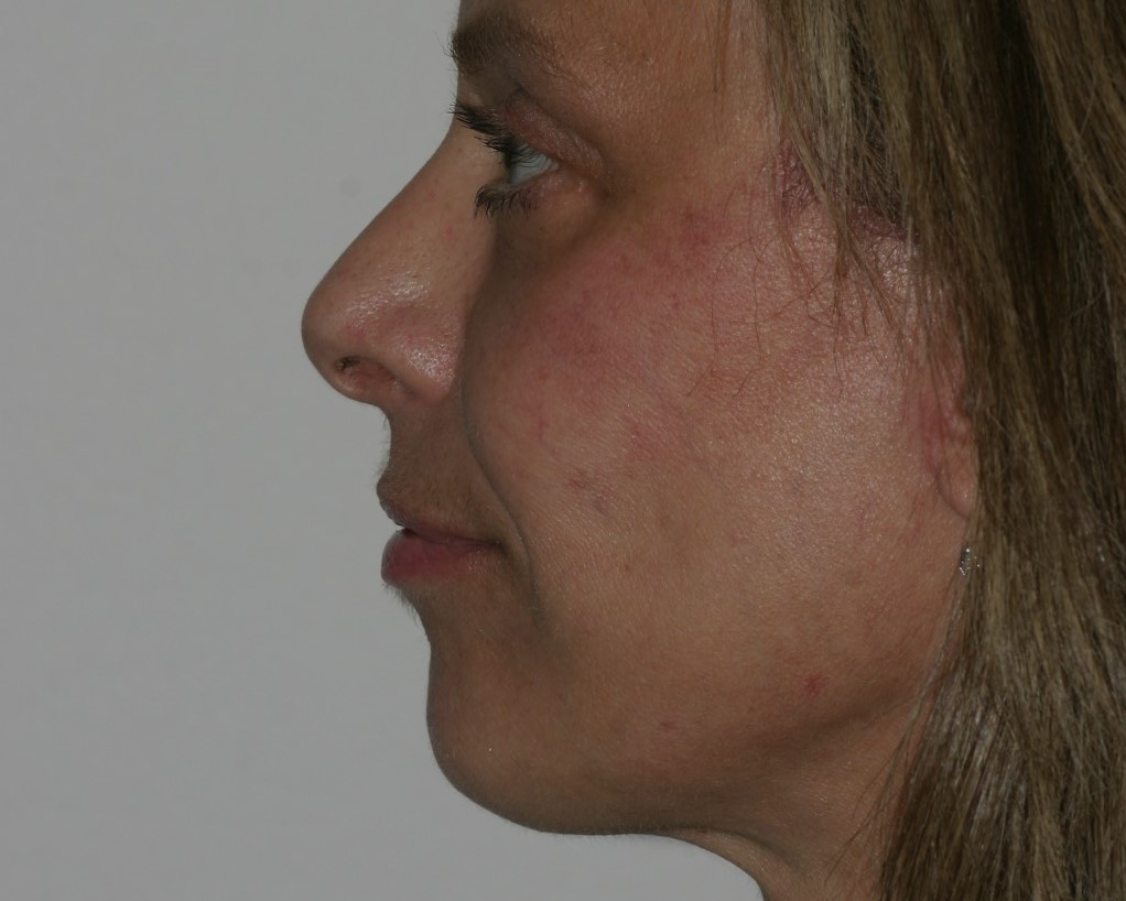 Face Lift - Before & After - Dr. Placik