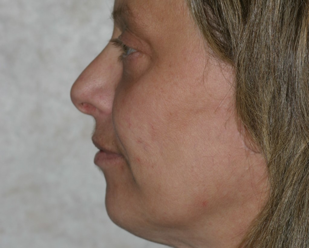 Face Lift - Before & After - Dr. Placik