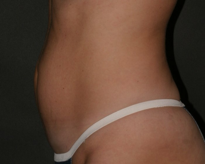 Tummy Tuck - Before & After - Dr. Placik