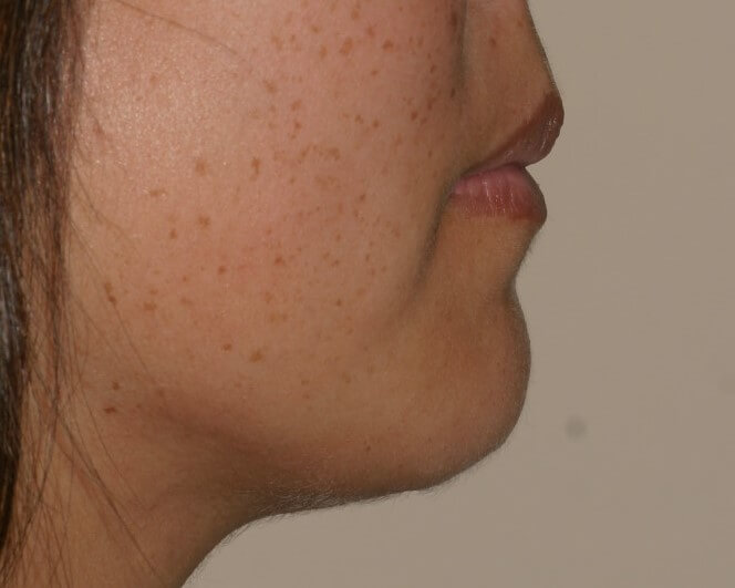 Chin Surgery - Before & After - Dr. Placik