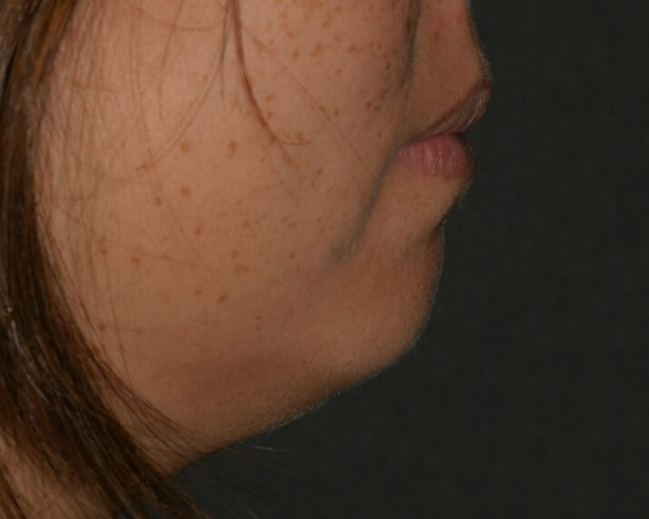 Chin Surgery - Before & After - Dr. Placik