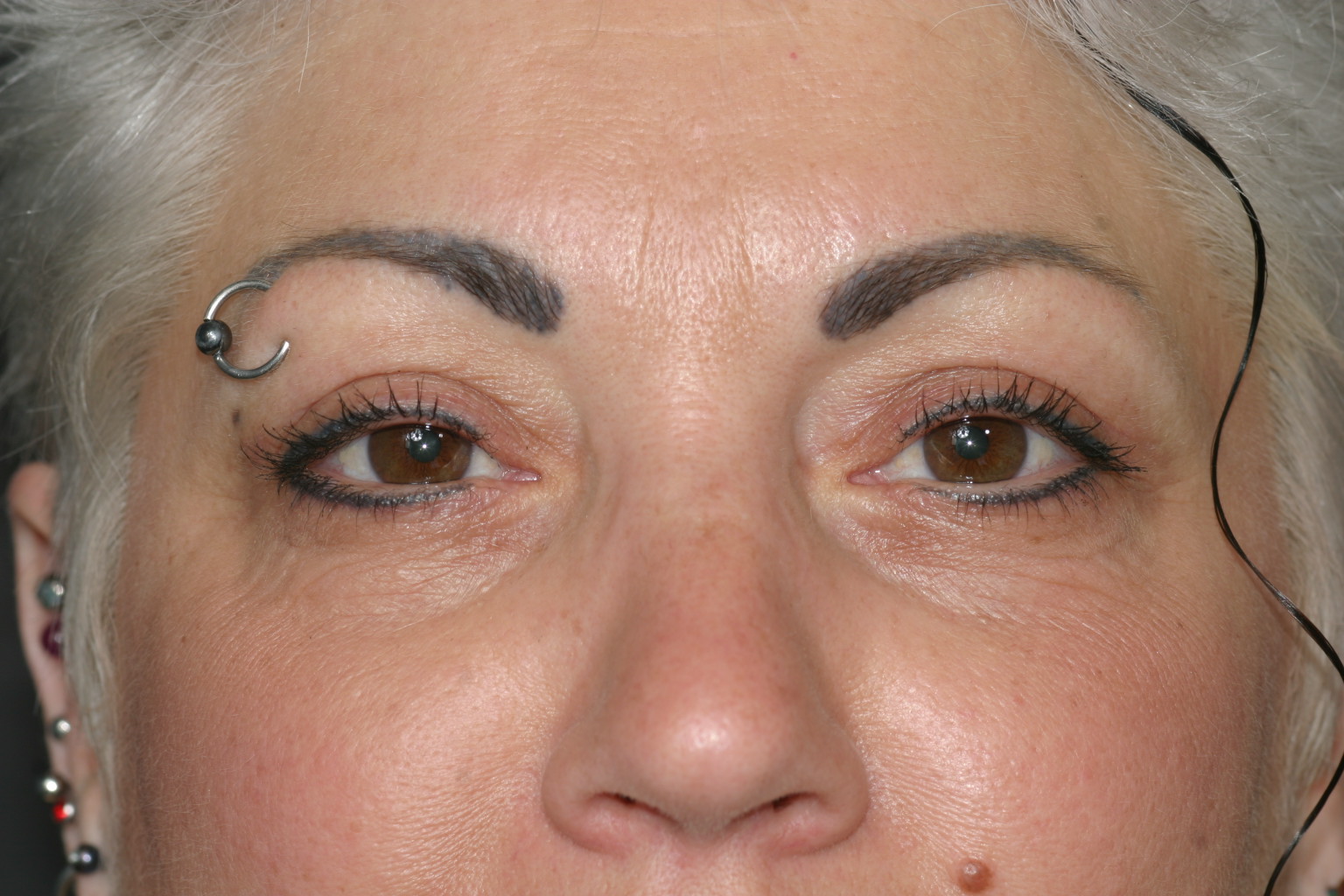 Eyelid Surgery - Before & After - Dr. Placik