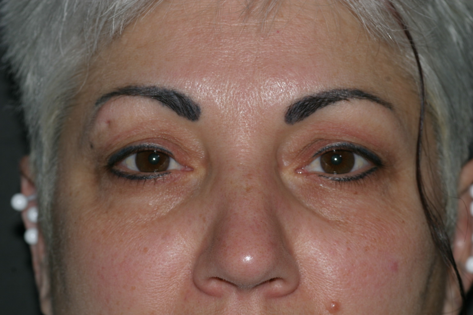 Eyelid Surgery - Before & After - Dr. Placik