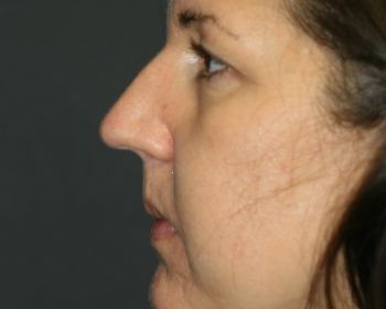 Injectable Filler - Before & After - Dr. Placik