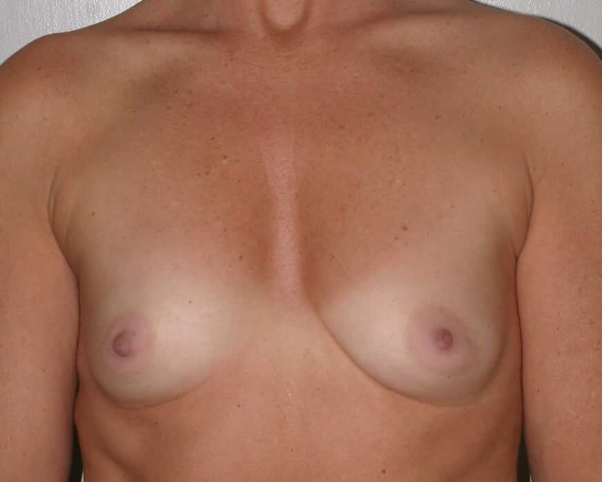 Before & After Breast Augmentation Gallery - Before & After - Dr. Placik