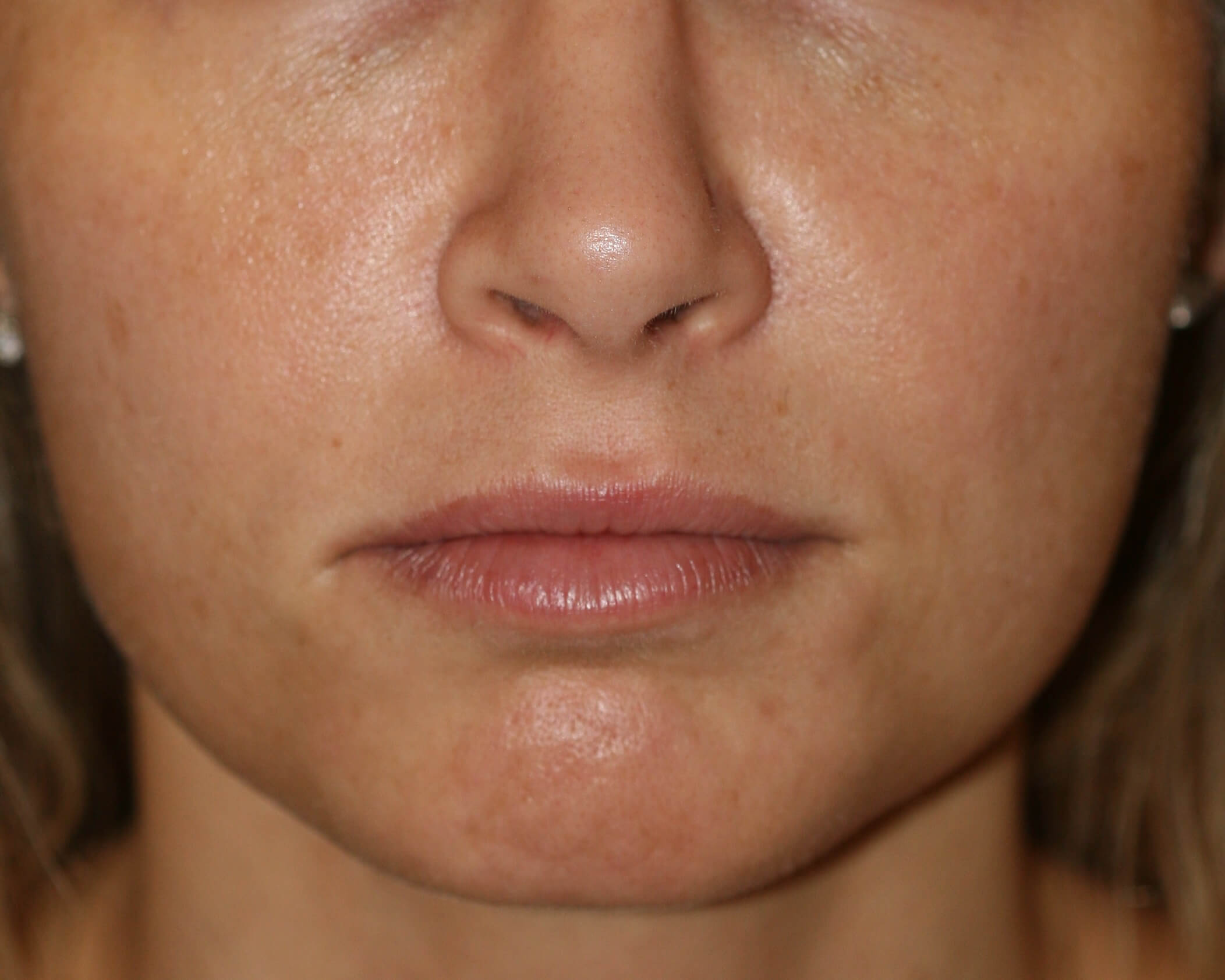 Injectable Filler - Before & After - Dr. Placik