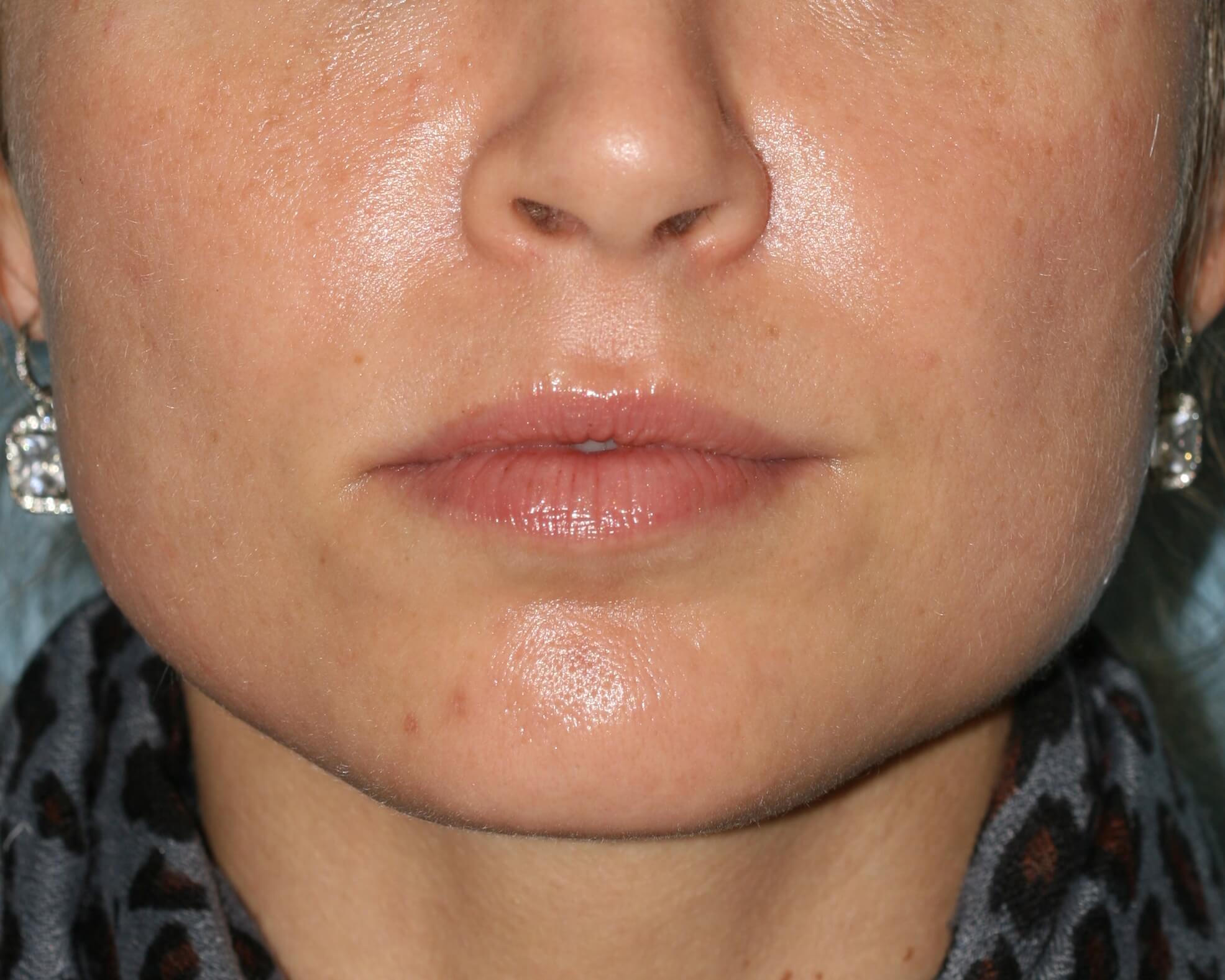 Injectable Filler - Before & After - Dr. Placik