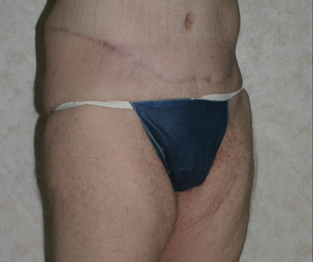 Thigh Lift - Before & After - Dr. Placik