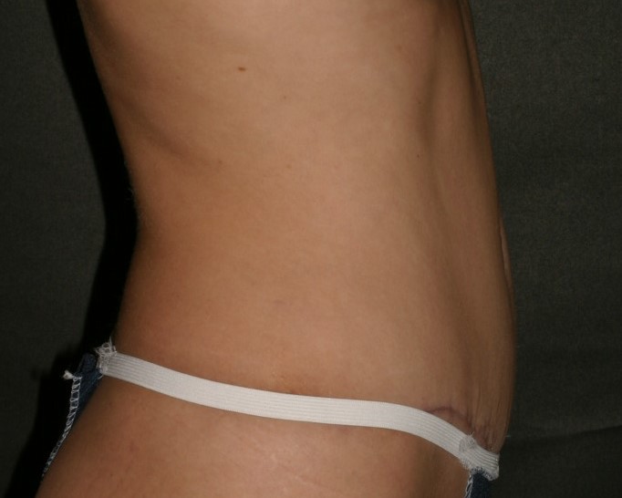 Tummy Tuck - Before & After - Dr. Placik