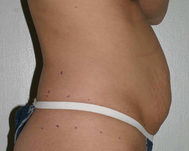 Tummy Tuck - Before & After - Dr. Placik